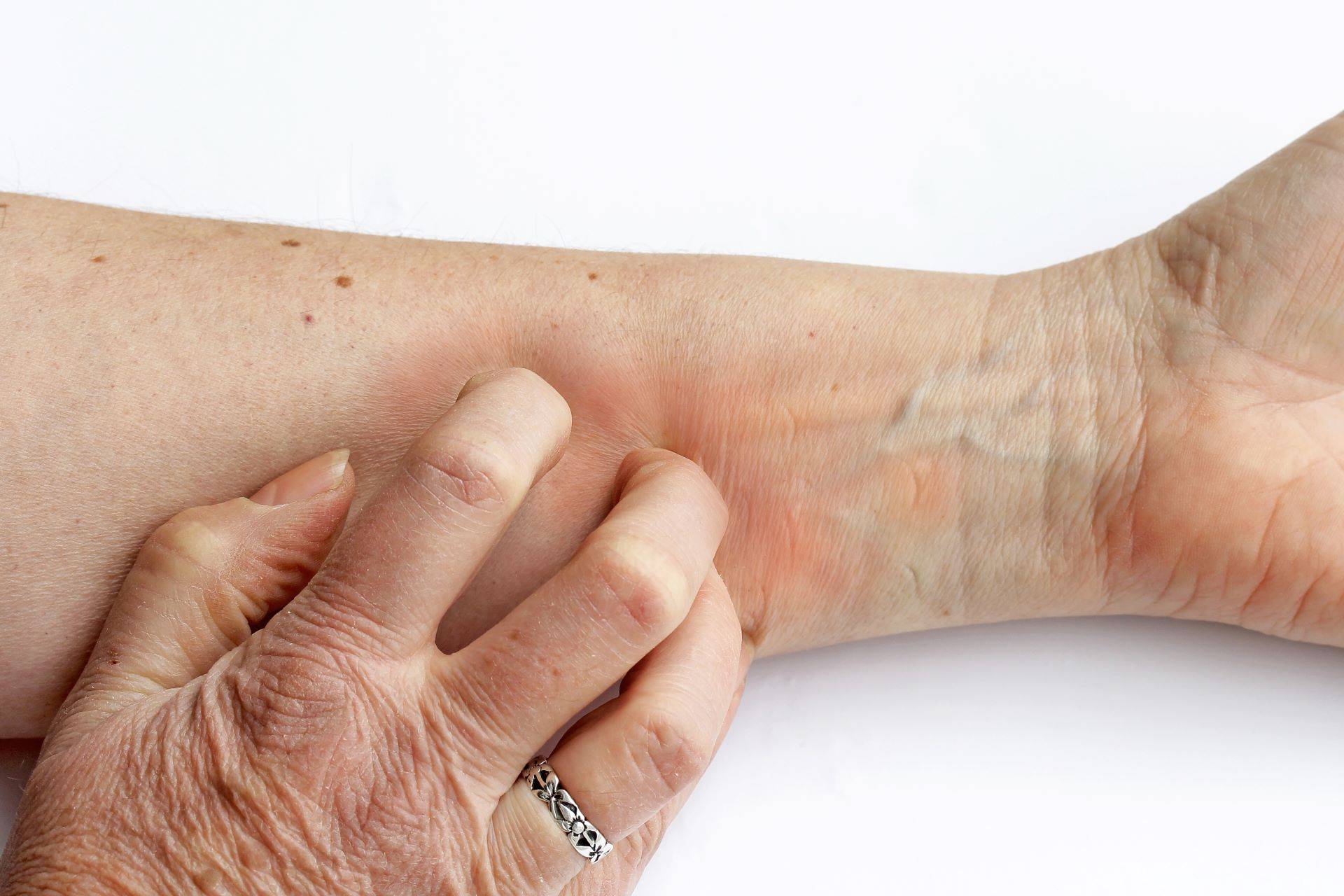 Hand kratzt gereizte Haut am Unterarm